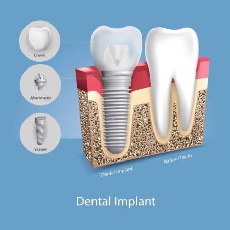 Diagram of the three components of a dental implant compared with a natural tooth.