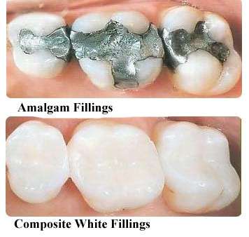 Top is a an amalgam filling and bottom is Composite white filling