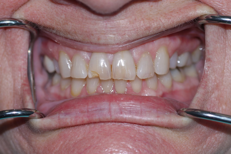Man smile showing broken tooth