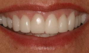 Person smiling and showing their top front teeth, showing 11 teeth