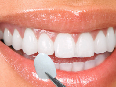 A woman's smile with a single porcelain veneer help next to a lateral incisor