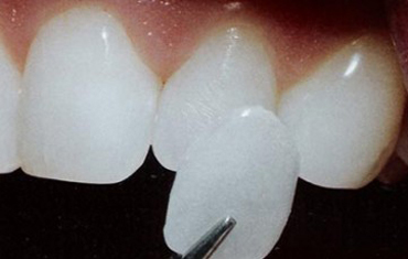 The tip of dental forceps are holding a porcelain veneer next to a lateral incisor tooth