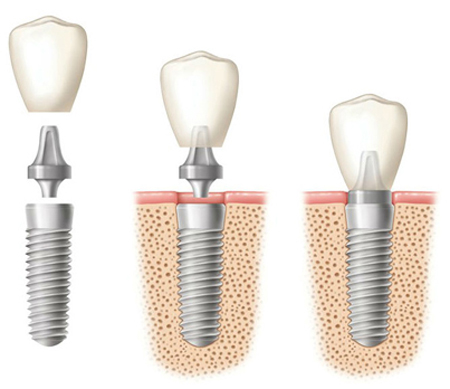 Diagram of three phases of a dental implant: separate compoonent, implant screw in the bone, and the crown attached