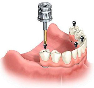 Diagram of a lower implant overdenture screwing onto dental implants