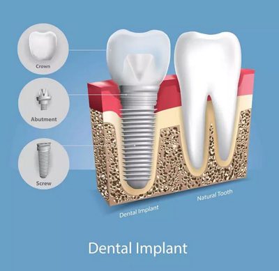 Diagram of dental implant components and a dental implant in the bone next to a natural tooth