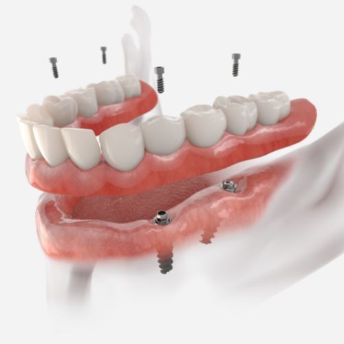 Implant overdenture with four implant screws hovering above the denture