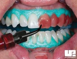 In-office teeth whitening, similar to Zoom, being applied to teeth