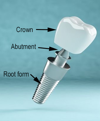 Dental implant with components identified - crown, abutment, and root form