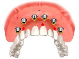 Illustration of implant overdentures