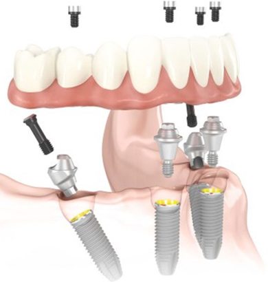 An illustration of all-on-four dental implants