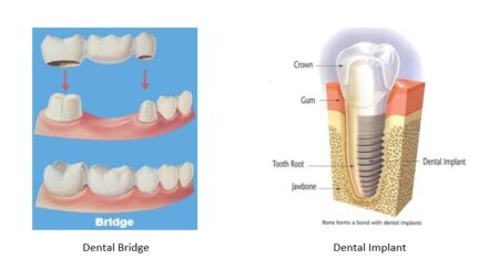 Illustration of a dental bridge versus a dental implant