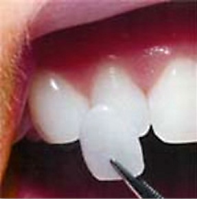 A porcelain veneer being held up to a tooth. 