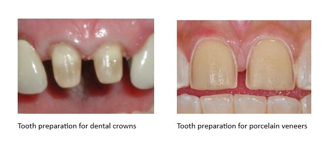 Tooth preparation for crowns versus veneers