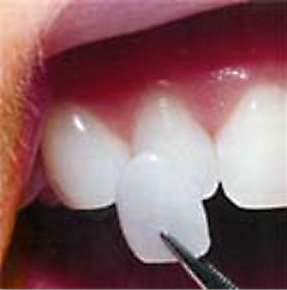 A porcelain veneer being held on to a tooth  